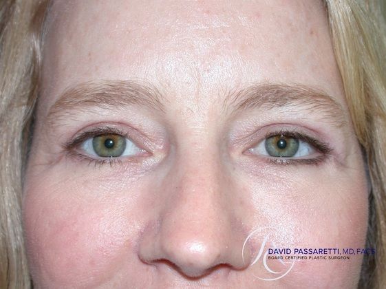 Eyelid surgery Before & After