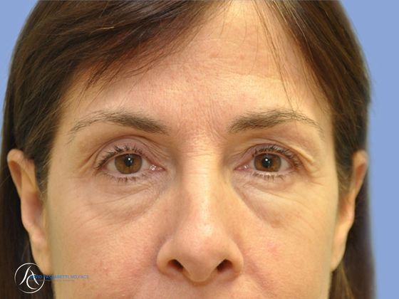 Eyelid surgery Before & After