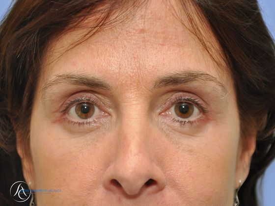 Eyelid surgery Before & After