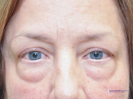 Eyelid surgery Before & After