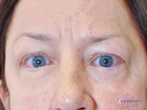 Eyelid surgery Before & After