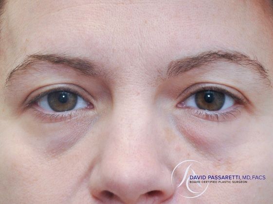 Eyelid surgery Before & After