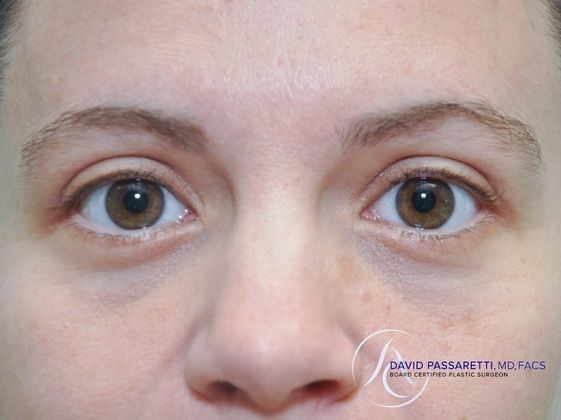 Eyelid surgery Before & After