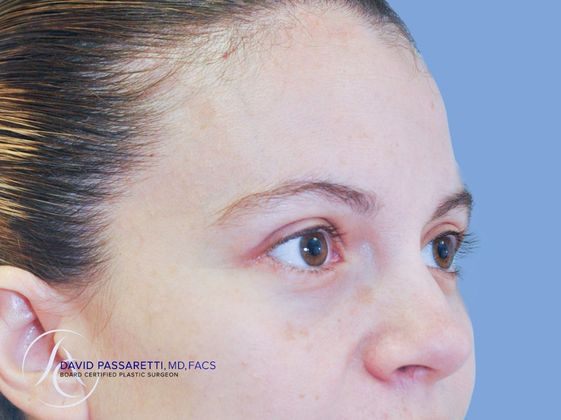 Eyelid surgery Before & After