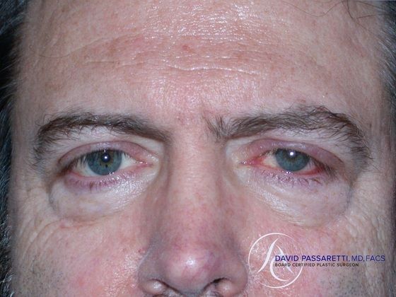 Eyelid surgery Before & After