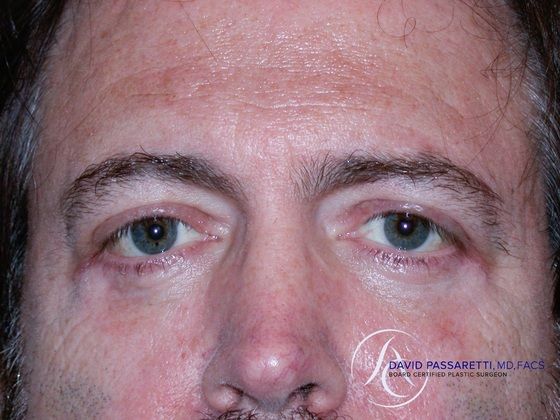 Eyelid surgery Before & After