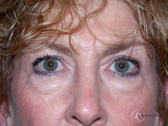 Eyelid surgery Before & After