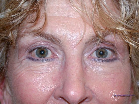 Eyelid surgery Before & After