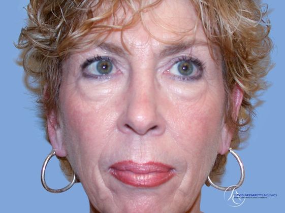 Eyelid surgery Before & After