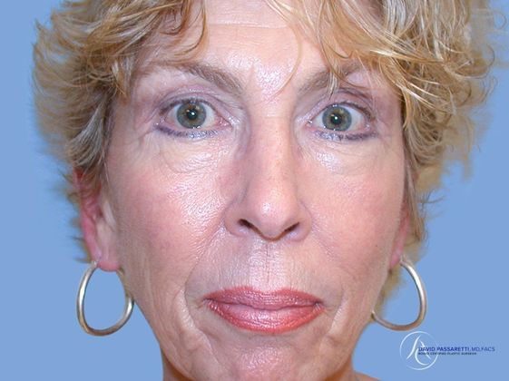 Eyelid surgery Before & After