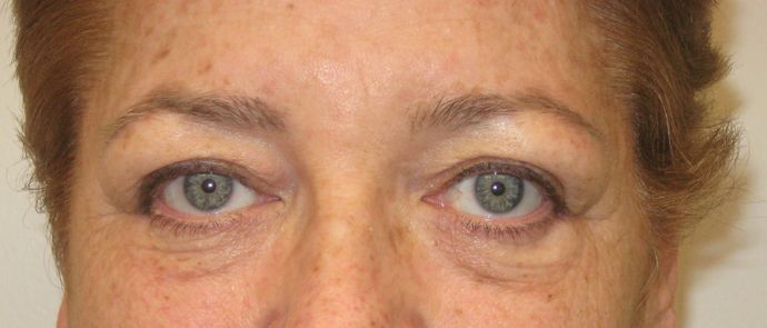 Eyelid surgery Before & After