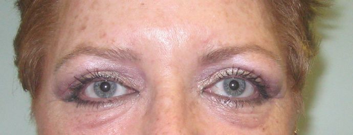 Eyelid surgery Before & After