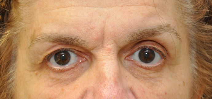 Eyelid surgery Before & After