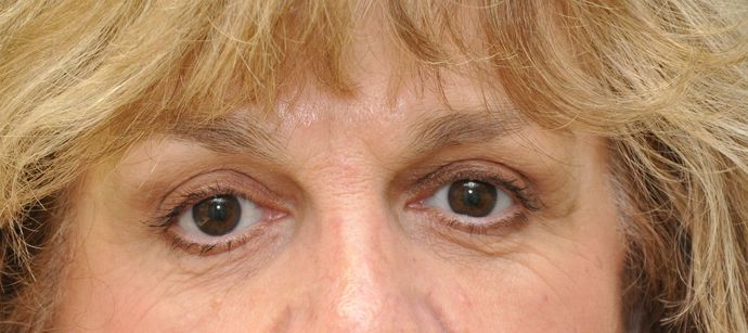 Eyelid surgery Before & After