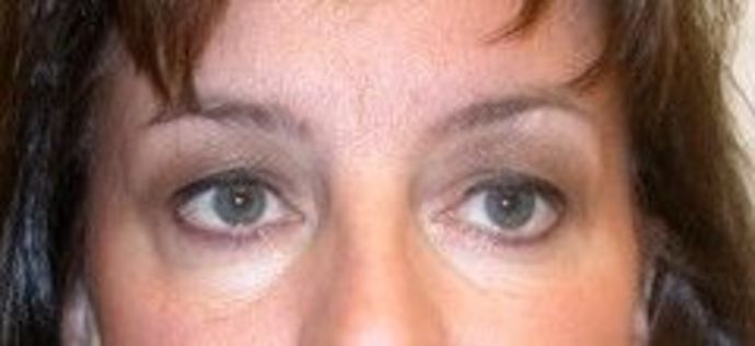 Eyelid surgery Before & After