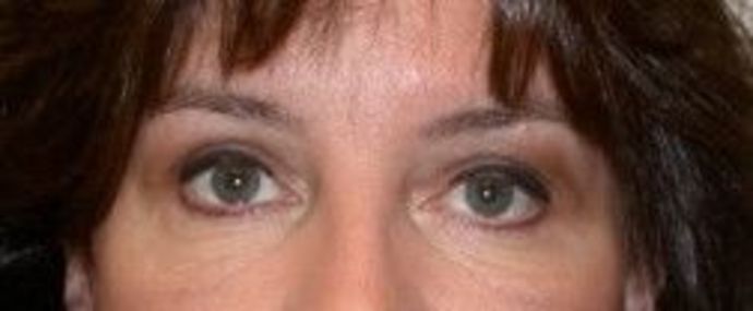 Eyelid surgery Before & After