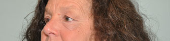 Eyelid surgery Before & After