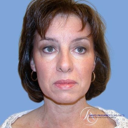 Facelift Before & After