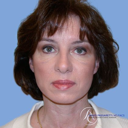 Facelift Before & After