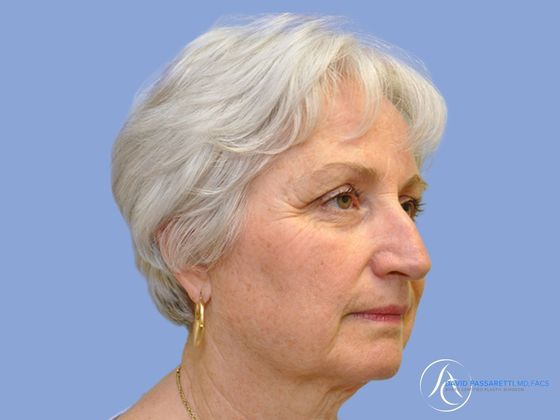 Facelift Before & After