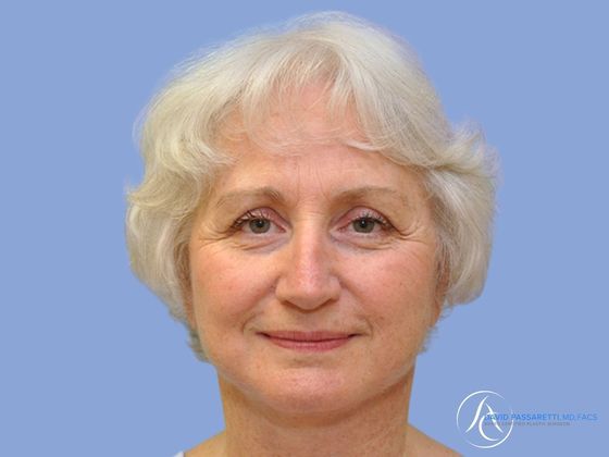 Facelift Before & After