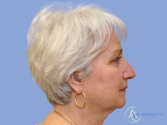 Facelift Before & After