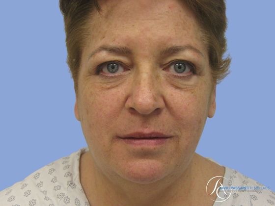 Facelift Before & After