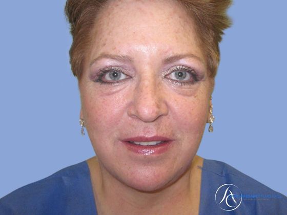 Facelift Before & After