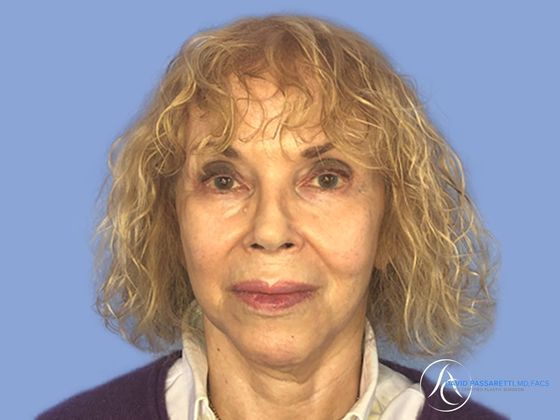 Facelift Before & After