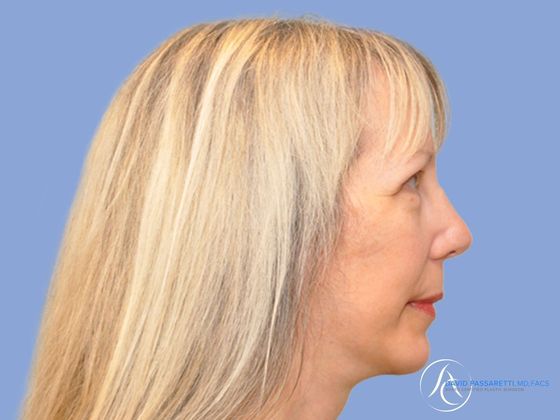 Facelift Before & After