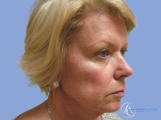 Facelift Before & After