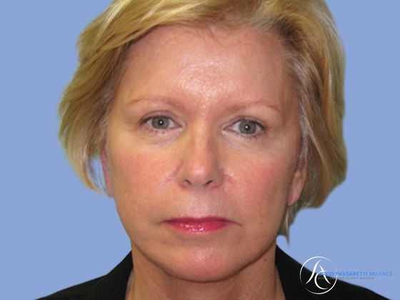 Facelift Before & After