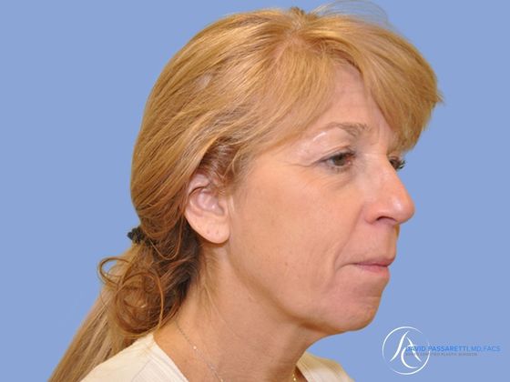 Facelift Before & After