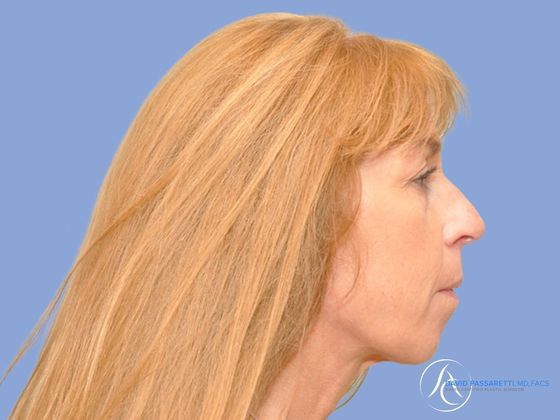 Facelift Before & After