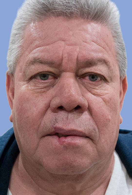Facial reconstruction Before & After