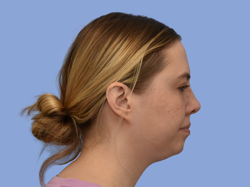 Neck liposuction Before & After