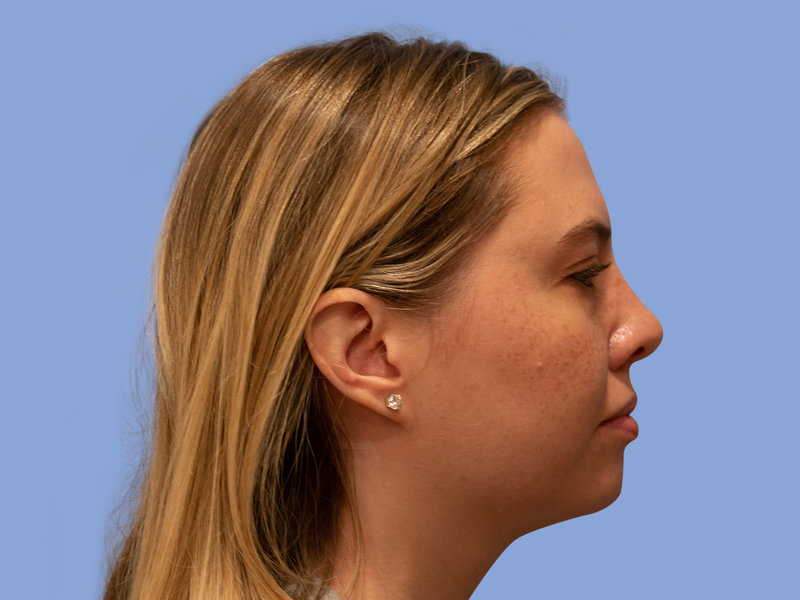 Neck liposuction Before & After