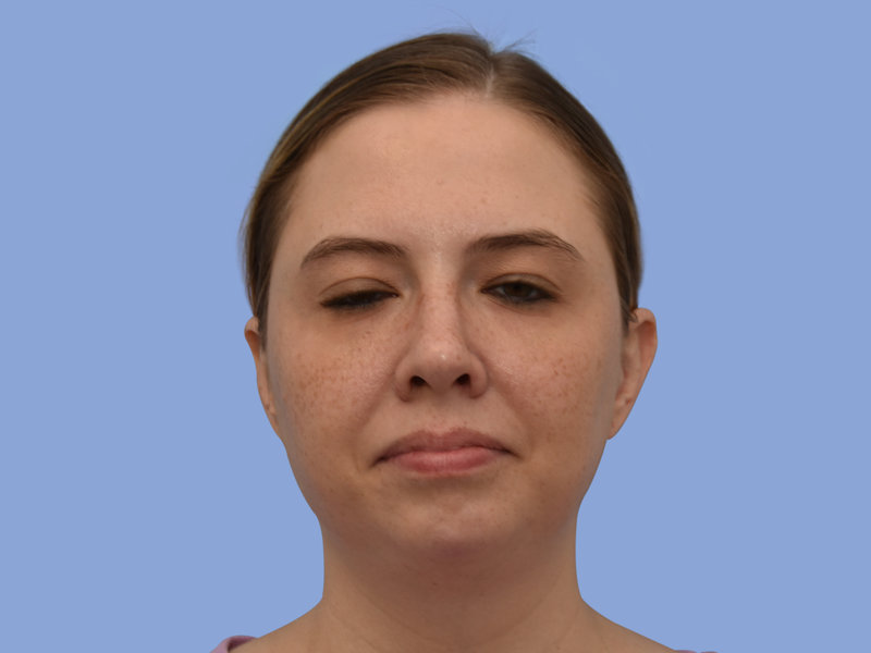 Neck liposuction Before & After
