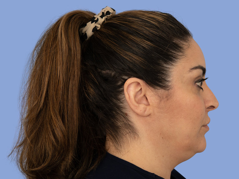 Neck liposuction Before & After