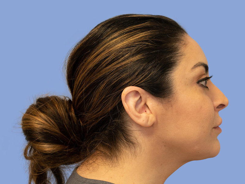 Neck liposuction Before & After