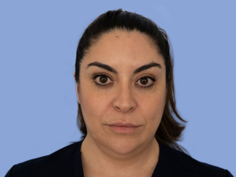 Neck liposuction Before & After