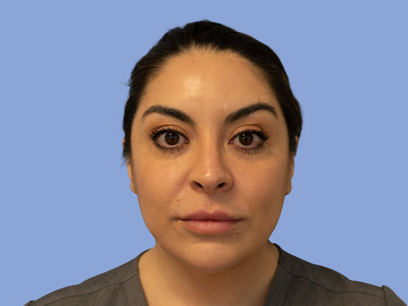 Neck liposuction Before & After