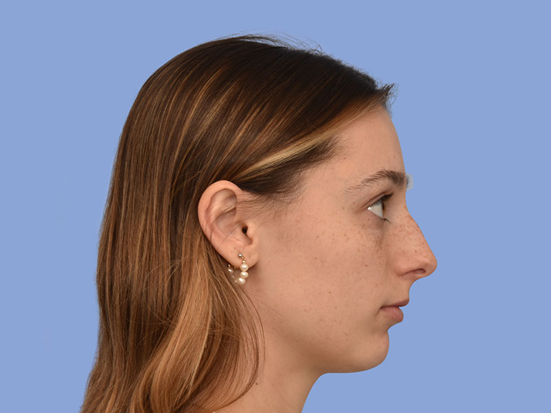 Rhinoplasty Before & After