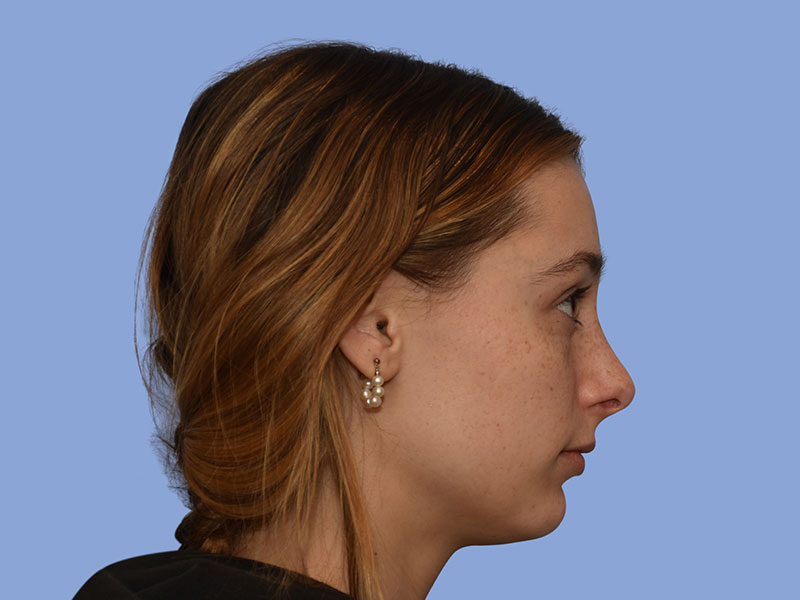 Rhinoplasty Before & After