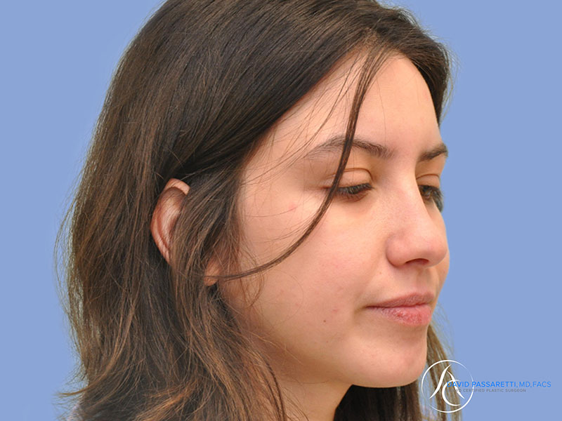 Rhinoplasty Before & After