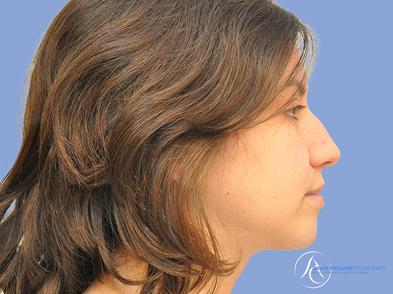 Rhinoplasty Before & After