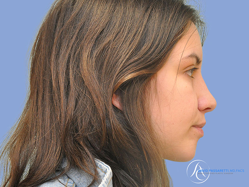 Rhinoplasty Before & After