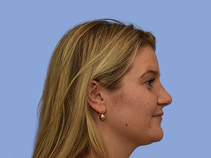 Rhinoplasty Before & After