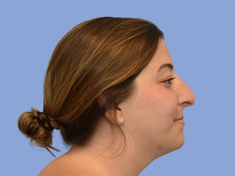 Rhinoplasty Before & After