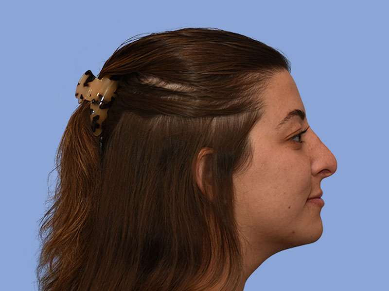 Rhinoplasty Before & After